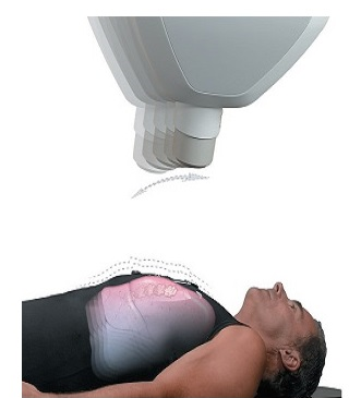 CyberKnife tedavisi sırasında hastayı gösteren kaynak görsel